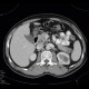 Pancreatic cysts and renal cysts in von Hippel-Lindau disease: CT - Computed tomography